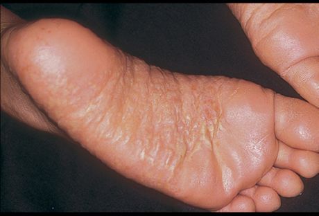 Dermatitis nogu i njezini uzroci