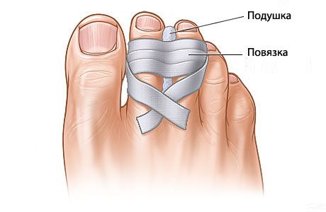 Kakve su izgledi za obnovu slomljenih prstiju?