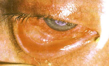 Sindrom Stevens-Johnson.  Dvostrani desquamative konjunktivitis s područjima nekroze.  Teški keratitis, koji je izazvao ožiljke na rožnici.  Situacija je bila komplicirana dodavanjem sindroma "suhih" očiju