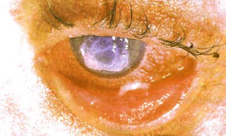 Sindrom Stevens-Johnson.  Dvostrani desquamative konjunktivitis s područjima nekroze.  Teški keratitis, koji je izazvao ožiljke na rožnici.  Situacija je bila komplicirana dodavanjem sindroma "suhih" očiju
