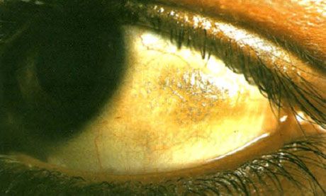 Xerophthalmia.  Bitoovi plakovi izgledaju povišeni, s odstranjivanjem višestrukih vage, mjesta konjunktivnih mjesta koja se nalaze u zoni koja nije prekrivena kapcima.  Kao u ovom slučaju, patološka područja često su pigmentirana.