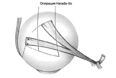 Strabizam - Operacija