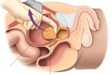 Rad Adenomectomije Nadvoznjak Retropubicni Kompetentno O Zdravlju Na Ilive