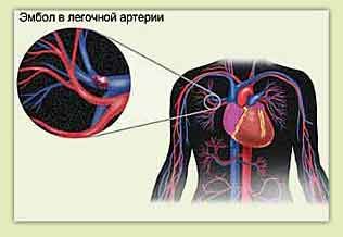 Pulmonarna embolija i bolovi u prsima lijevo