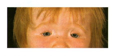 Dvostrani coloboma kapaka u djeteta s Zlatnim sindromom.  Zatvaranje oka na lijevoj strani